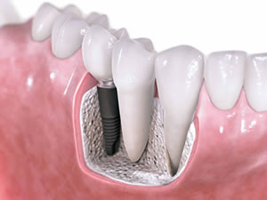 implantology sri lanka