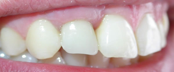 Dental Implants Colombo