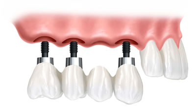 multipe implants